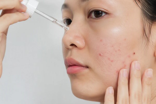 Acid Hyaluronic có thích hợp cho da mụn không? Cần chú ý gì khi dùng? 1 Acid Hyaluronic có thích hợp cho da mụn không? Cần chú ý gì khi dùng? 2