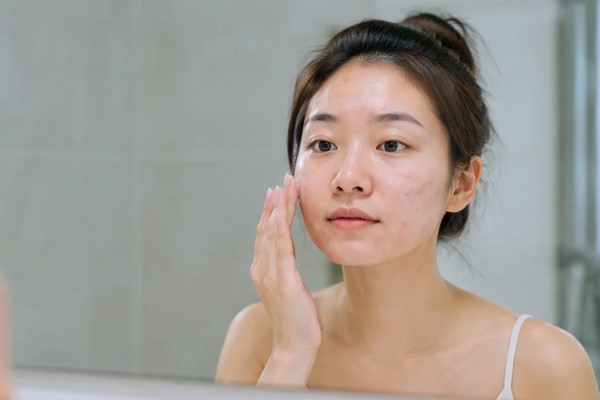 Acid Hyaluronic có thích hợp cho da mụn không? Cần chú ý gì khi dùng? 2 Acid Hyaluronic có thích hợp cho da mụn không? Cần chú ý gì khi dùng? 3